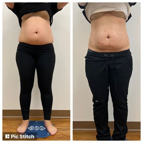 emsculpt temecula, ca|7 Emsculpt doctors & clinics in Temecula, CA .